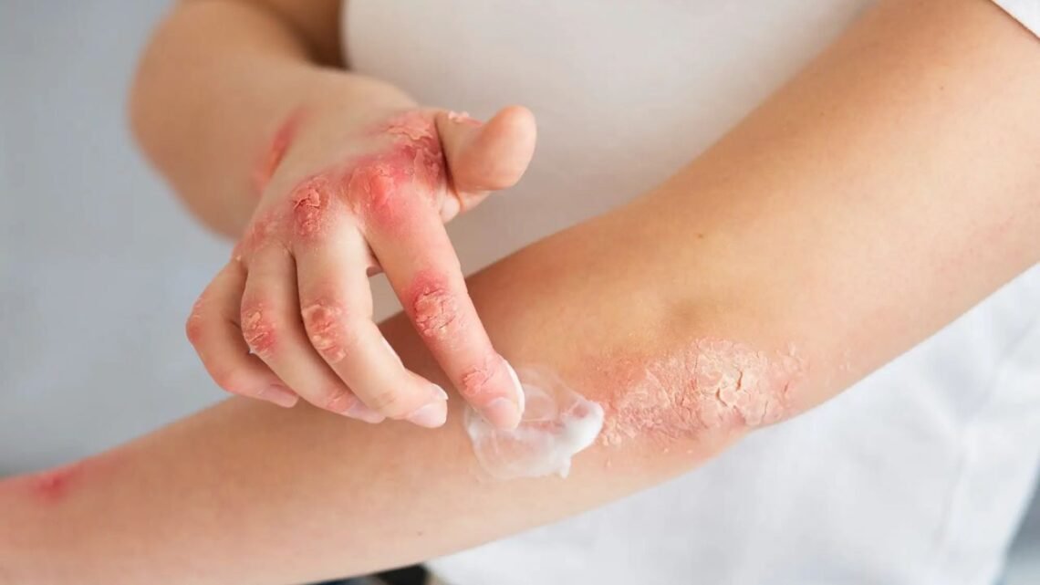 Skin Allergy Ayurvedic Treatment