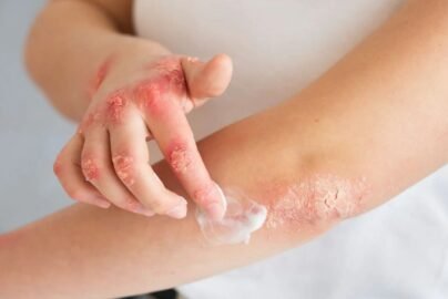 Skin Allergy Ayurvedic Treatment