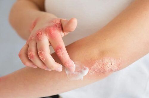 Skin Allergy Ayurvedic Treatment