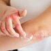 Skin Allergy Ayurvedic Treatment